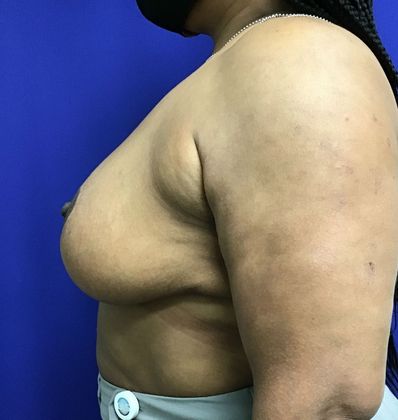 Breast Reduction: Case 33 (30183) - After