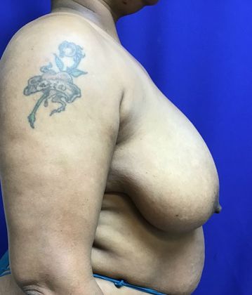 Breast Reduction: Case 33 (30183) - Before