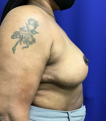 Breast Reduction: Case 33 (30183) - After