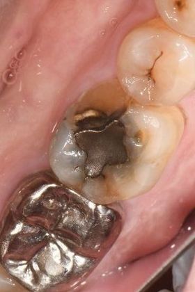 Crowns Case 16 -  Meyersville, TX - Before