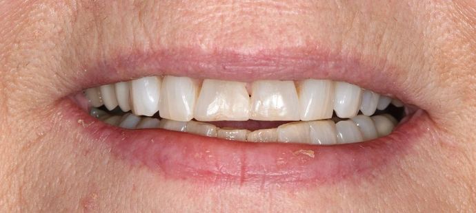Tooth-colored Fillings Case 18 - Victoria, TX - After