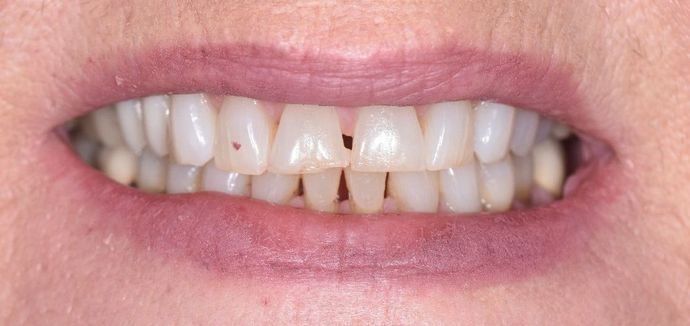 Tooth-colored Fillings Case 18 - Victoria, TX - Before