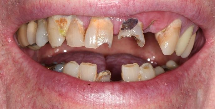 Tooth-colored Fillings: Case 20 - Before