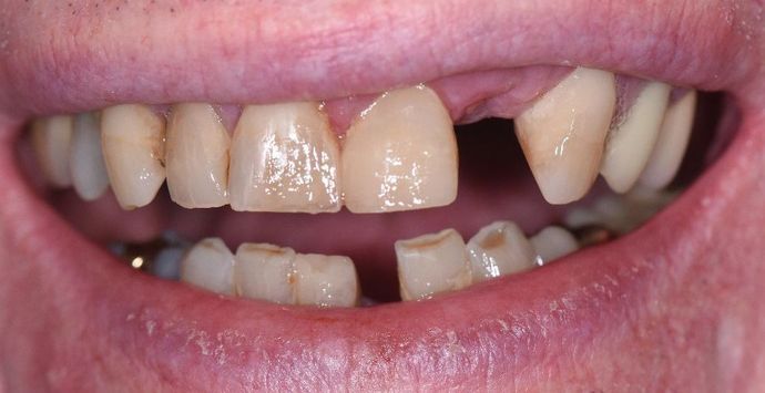 Tooth-colored Fillings: Case 20 - After