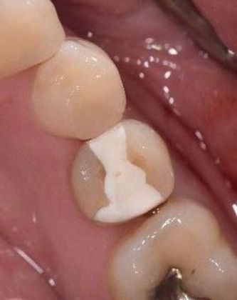 Crowns Case 17 - Cuero, TX - Before