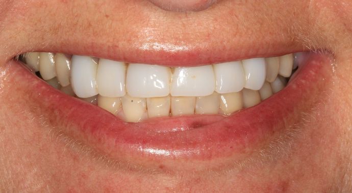 Full Mouth Reconstruction: Case 7 - Before