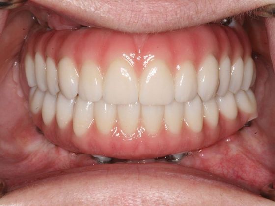 All-on-4/ Full Mouth Dental Implants / Teeth in a Day: Case 1-WG- Upper and lower All-on-4 bridges - After