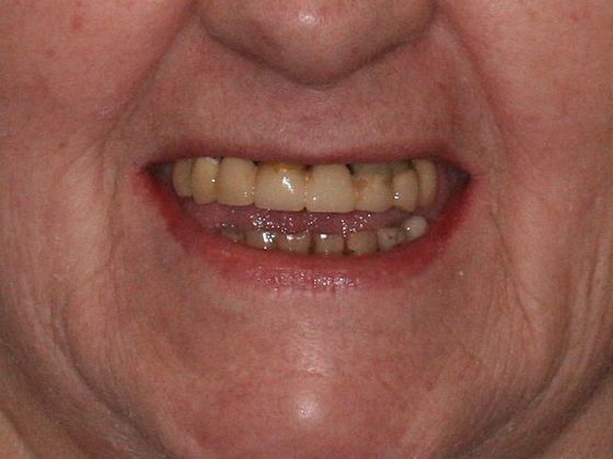All-on-4/ Full Mouth Dental Implants / Teeth in a Day: Case 1-WG- Upper and lower All-on-4 bridges - Before