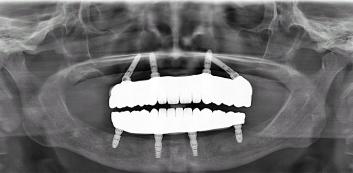 All-on-4/ Full Mouth Dental Implants / Teeth in a Day: Case 1-WG- Upper and lower All-on-4 bridges - After