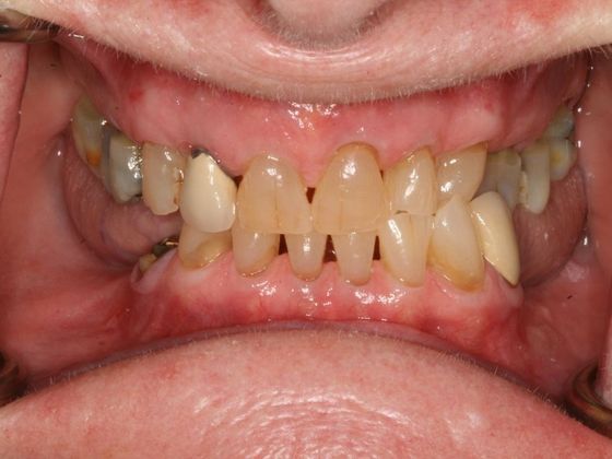 All-on-4/ Full Mouth Dental Implants / Teeth in a Day: Case 2-MS- Upper and lower All-on-4 bridges - Before