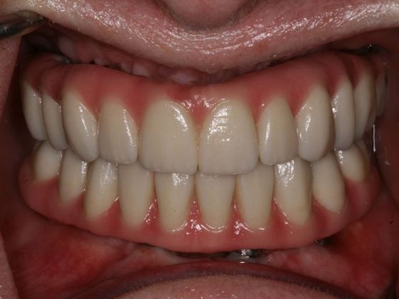 All-on-4/ Full Mouth Dental Implants / Teeth in a Day: Case 2-MS- Upper and lower All-on-4 bridges - After
