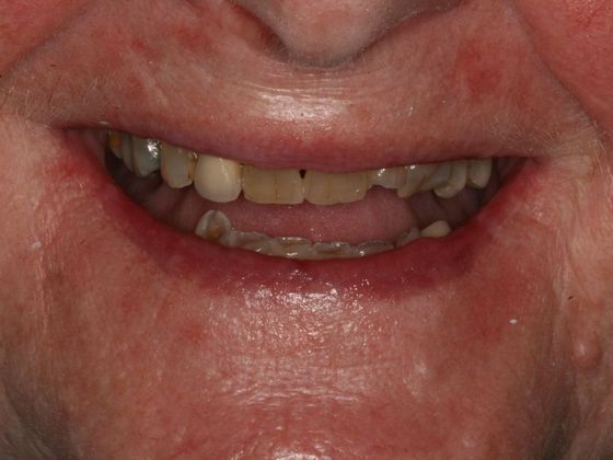 All-on-4/ Full Mouth Dental Implants / Teeth in a Day: Case 2-MS- Upper and lower All-on-4 bridges - Before