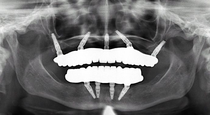 All-on-4/ Full Mouth Dental Implants / Teeth in a Day: Case 2-MS- Upper and lower All-on-4 bridges - After