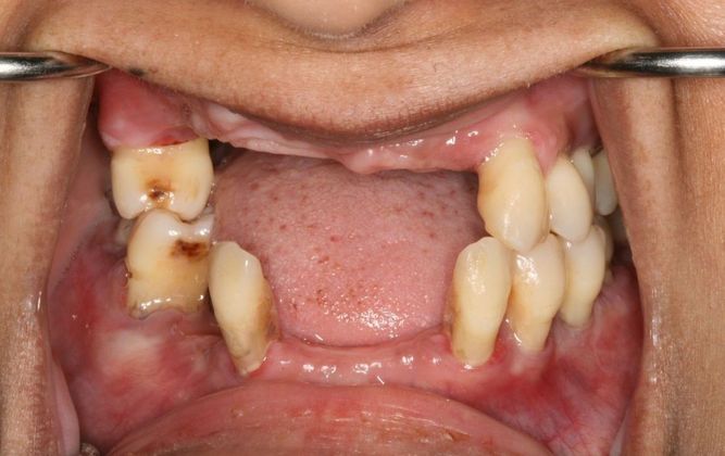 All-on-4/ Full Mouth Dental Implants / Teeth in a Day Case 3-JG-Upper and lower All-on-4 bridges  - Before