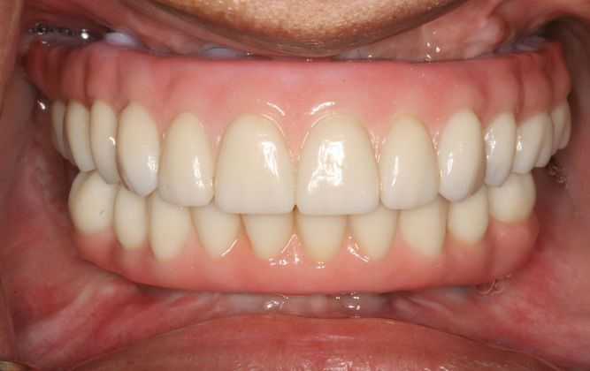 All-on-4/ Full Mouth Dental Implants / Teeth in a Day Case 3-JG-Upper and lower All-on-4 bridges  - After