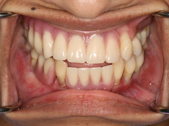 All-on-4/ Full Mouth Dental Implants / Teeth in a Day: Case 3-JG-Upper and lower All-on-4 bridges - Before