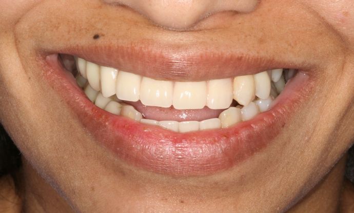 All-on-4/ Full Mouth Dental Implants / Teeth in a Day: Case 3-JG-Upper and lower All-on-4 bridges - Before