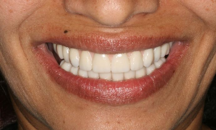 All-on-4/ Full Mouth Dental Implants / Teeth in a Day: Case 3-JG-Upper and lower All-on-4 bridges - After