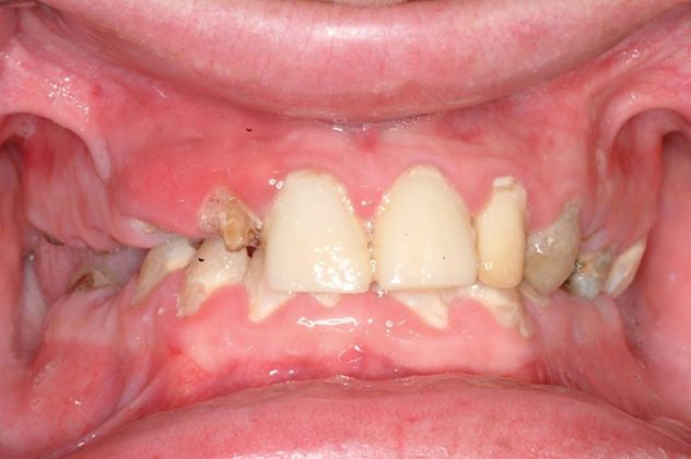 All-on-4/ Full Mouth Dental Implants / Teeth in a Day: Case 4-ZS- Upper and lower implant bridges - Before