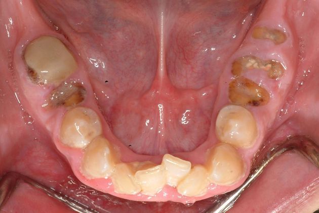 All-on-4/ Full Mouth Dental Implants / Teeth in a Day: Case 4-ZS- Upper and lower implant bridges - Before