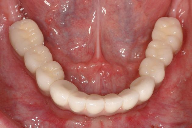 All-on-4/ Full Mouth Dental Implants / Teeth in a Day: Case 4-ZS- Upper and lower implant bridges - After