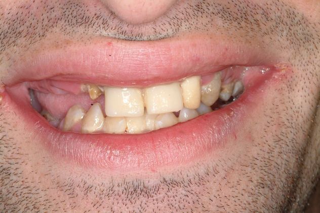 All-on-4/ Full Mouth Dental Implants / Teeth in a Day: Case 4-ZS- Upper and lower implant bridges - Before