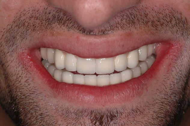 All-on-4/ Full Mouth Dental Implants / Teeth in a Day: Case 4-ZS- Upper and lower implant bridges - After