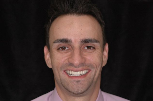 All-on-4/ Full Mouth Dental Implants / Teeth in a Day: Case 4-ZS- Upper and lower implant bridges - After