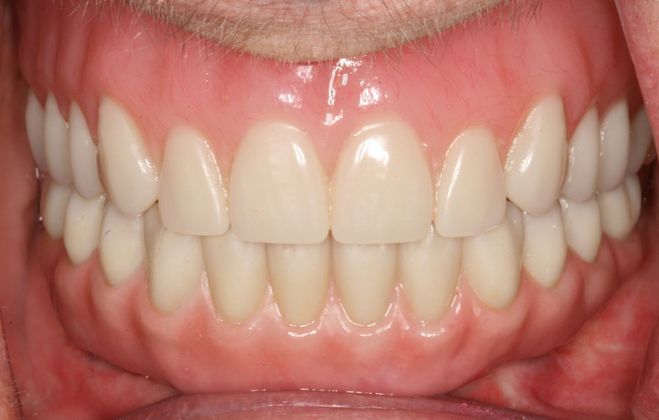 All-on-4/ Full Mouth Dental Implants / Teeth in a Day: Case 5- BB- Upper full denture and lower All-on-4 implant bridge - After