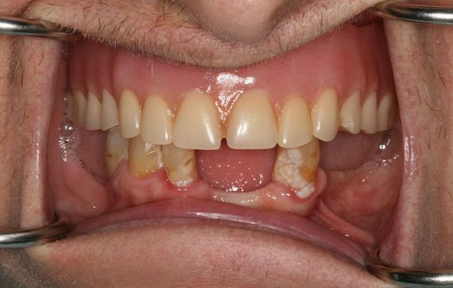 All-on-4/ Full Mouth Dental Implants / Teeth in a Day: Case 5- BB- Upper full denture and lower All-on-4 implant bridge - Before