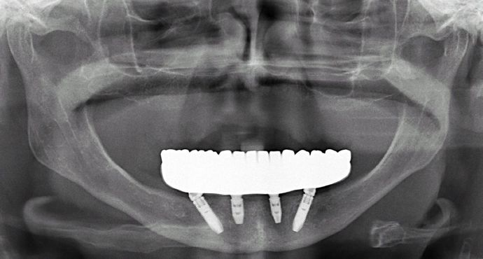 All-on-4/ Full Mouth Dental Implants / Teeth in a Day: Case 5- BB- Upper full denture and lower All-on-4 implant bridge - After