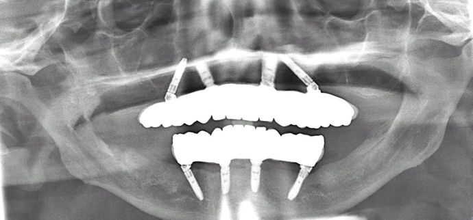 All-on-4/ Full Mouth Dental Implants / Teeth in a Day: Case 6-DG - Upper and lower All-on-4 implant bridges - After