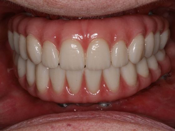 All-on-4/ Full Mouth Dental Implants / Teeth in a Day: Case 7-BB- Upper and lower All-on-4 bridges - After
