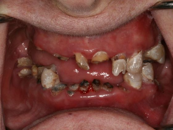 All-on-4/ Full Mouth Dental Implants / Teeth in a Day: Case 7-BB- Upper and lower All-on-4 bridges - Before