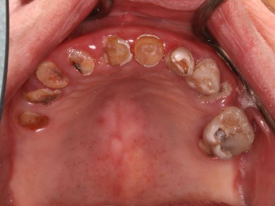 All-on-4/ Full Mouth Dental Implants / Teeth in a Day: Case 7-BB- Upper and lower All-on-4 bridges - Before