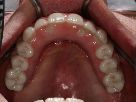 All-on-4/ Full Mouth Dental Implants / Teeth in a Day: Case 7-BB- Upper and lower All-on-4 bridges - After
