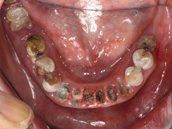 All-on-4/ Full Mouth Dental Implants / Teeth in a Day: Case 7-BB- Upper and lower All-on-4 bridges - Before