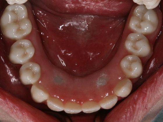 All-on-4/ Full Mouth Dental Implants / Teeth in a Day: Case 7-BB- Upper and lower All-on-4 bridges - After