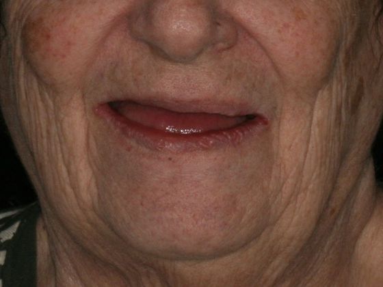 All-on-4/ Full Mouth Dental Implants / Teeth in a Day: Case 7-BB- Upper and lower All-on-4 bridges - Before