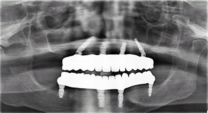 All-on-4/ Full Mouth Dental Implants / Teeth in a Day: Case 7-BB- Upper and lower All-on-4 bridges - After