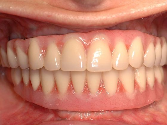 All-on-4/ Full Mouth Dental Implants / Teeth in a Day: Case 8-CG- Upper and lower implant bridges - After