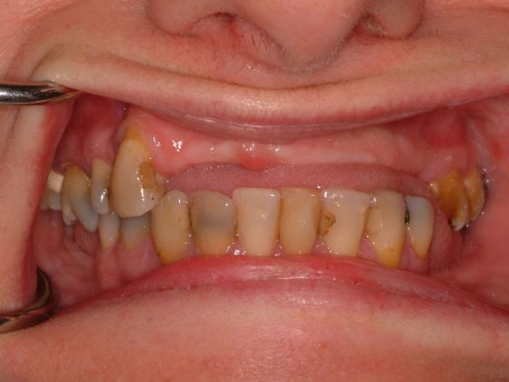 All-on-4/ Full Mouth Dental Implants / Teeth in a Day: Case 8-CG- Upper and lower implant bridges - Before