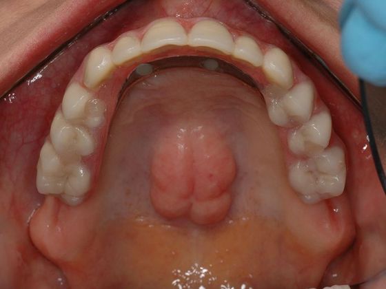 All-on-4/ Full Mouth Dental Implants / Teeth in a Day: Case 8-CG- Upper and lower implant bridges - After
