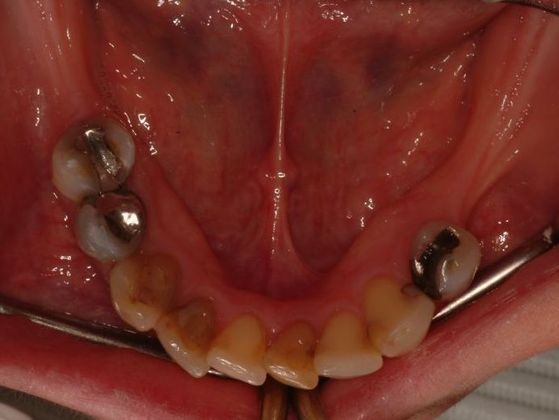 All-on-4/ Full Mouth Dental Implants / Teeth in a Day: Case 8-CG- Upper and lower implant bridges - Before