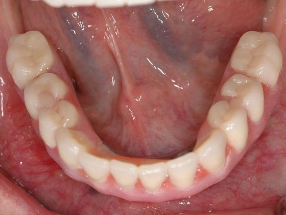 All-on-4/ Full Mouth Dental Implants / Teeth in a Day: Case 8-CG- Upper and lower implant bridges - After
