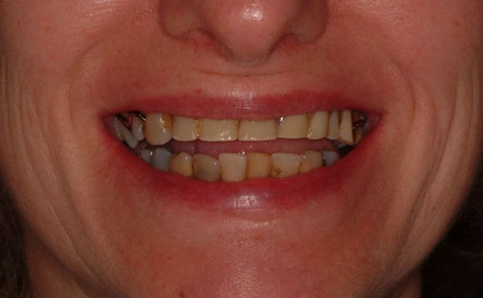 All-on-4/ Full Mouth Dental Implants / Teeth in a Day: Case 8-CG- Upper and lower implant bridges - Before