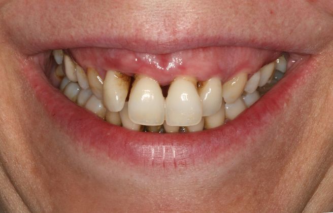 All-on-4/ Full Mouth Dental Implants / Teeth in a Day: Case 9-WA- Upper and lower All-on-4 bridges - Before