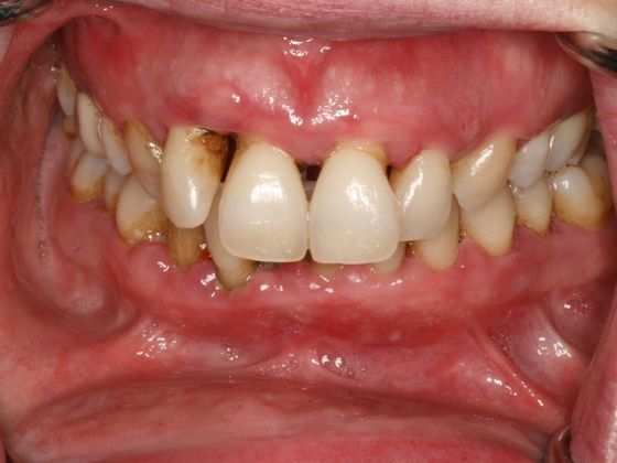 All-on-4/ Full Mouth Dental Implants / Teeth in a Day: Case 9-WA- Upper and lower All-on-4 bridges - After