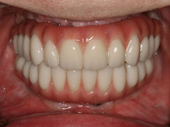 All-on-4/ Full Mouth Dental Implants / Teeth in a Day: Case 9-WA- Upper and lower All-on-4 bridges - Before