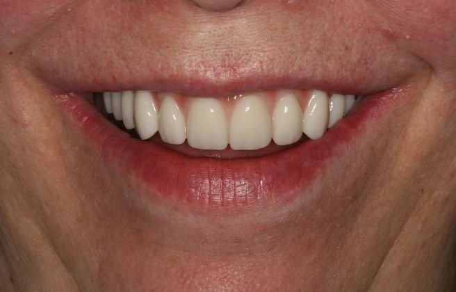 All-on-4/ Full Mouth Dental Implants / Teeth in a Day: Case 9-WA- Upper and lower All-on-4 bridges - After